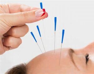 Read more about the article Managing Chronic Pain During Ottawa Winters: How I Use Acupuncture to Restore Comfort and Mobility